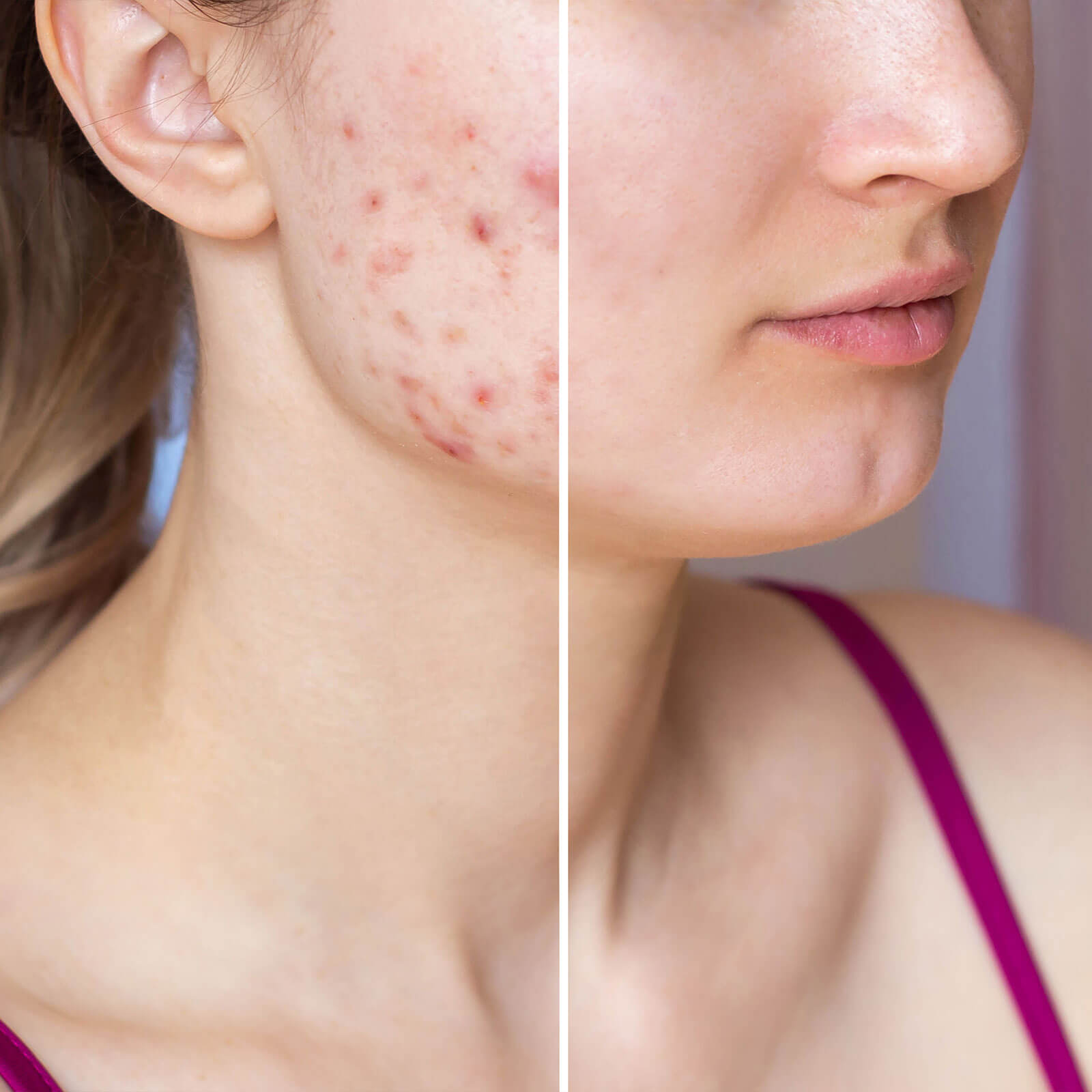 Sos anti-acne serum, morning care