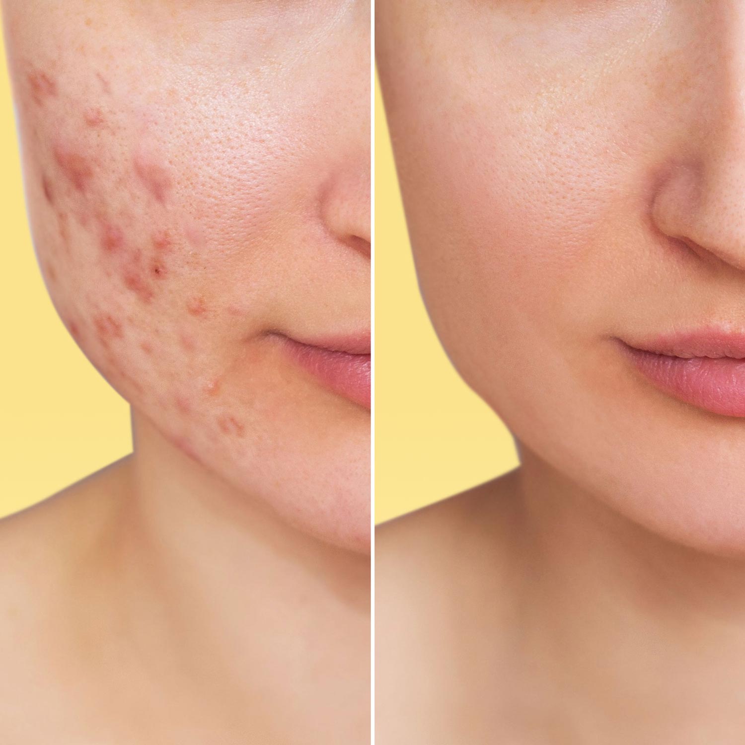 Sos anti-acne gel, evening care